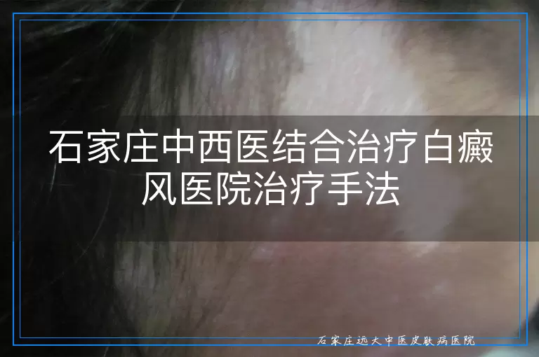 石家庄中西医结合治疗白癜风医院治疗手法