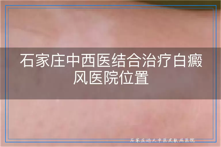 石家庄中西医结合治疗白癜风医院位置