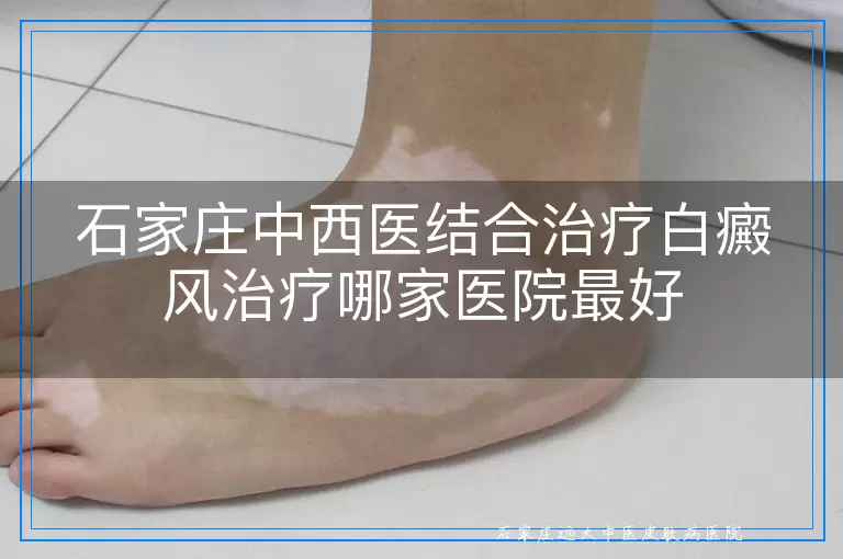 石家庄中西医结合治疗白癜风治疗哪家医院最好