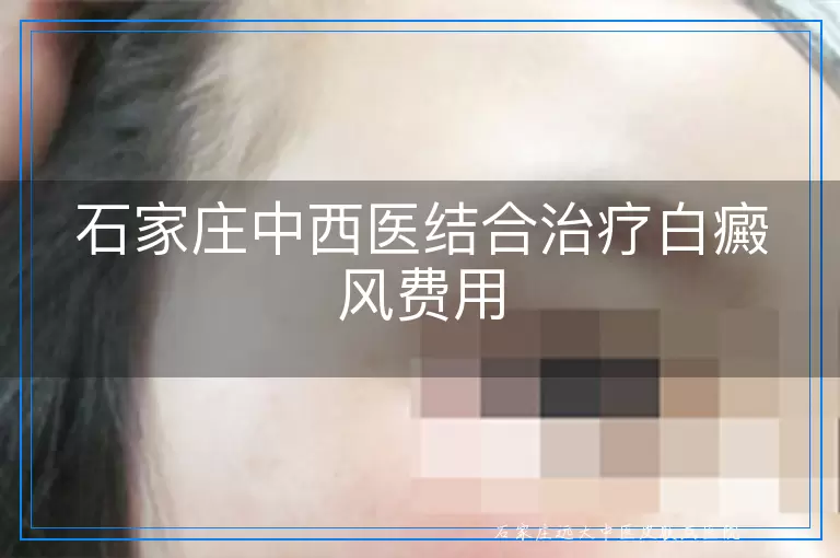 石家庄中西医结合治疗白癜风费用