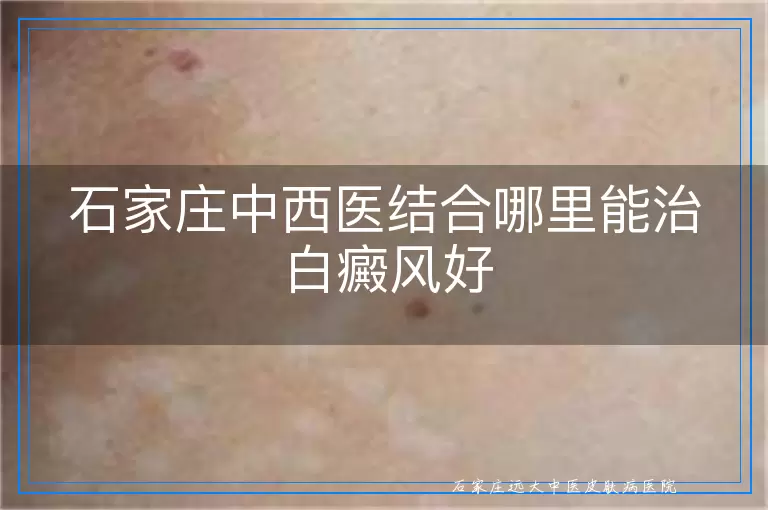 石家庄中西医结合哪里能治白癜风好