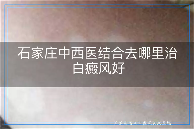 石家庄中西医结合去哪里治白癜风好