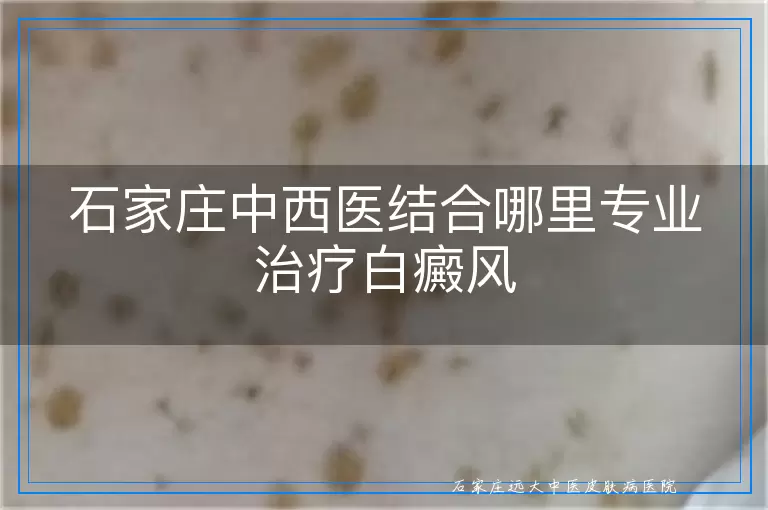 石家庄中西医结合哪里专业治疗白癜风