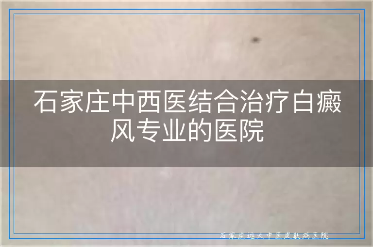 石家庄中西医结合治疗白癜风专业的医院