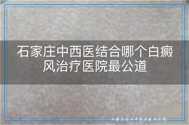 石家庄中西医结合哪个白癜风治疗医院最公道