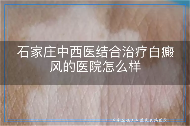 石家庄中西医结合治疗白癜风的医院怎么样