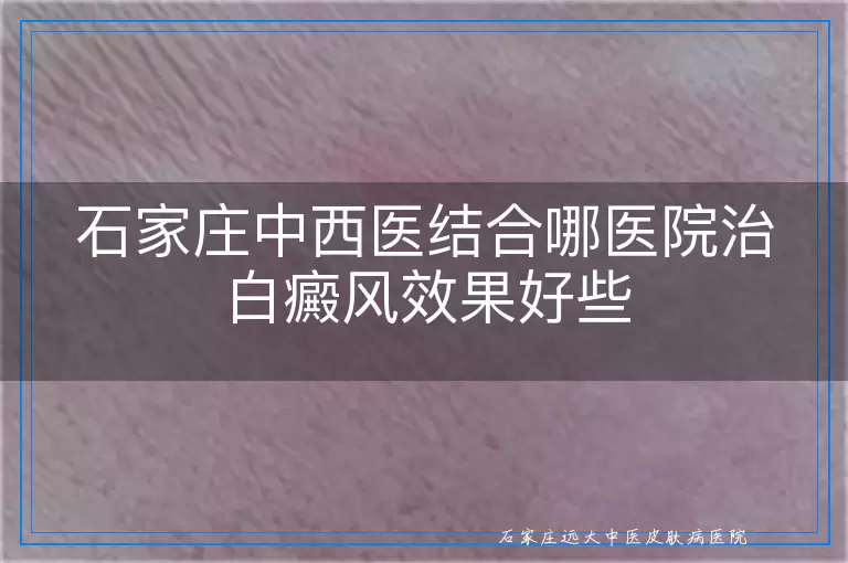 石家庄中西医结合哪医院治白癜风效果好些