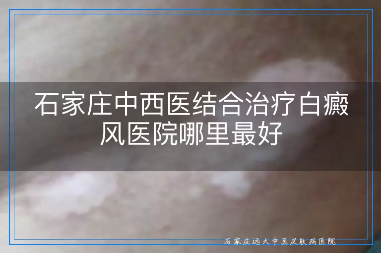 石家庄中西医结合治疗白癜风医院哪里最好