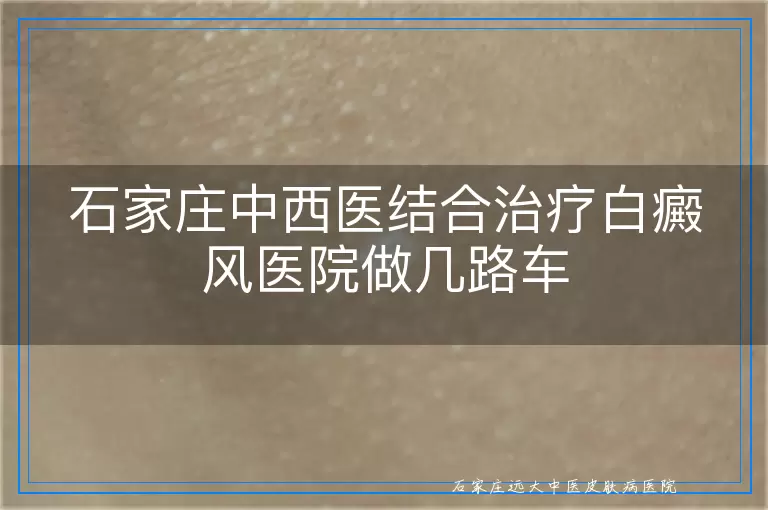 石家庄中西医结合治疗白癜风医院做几路车