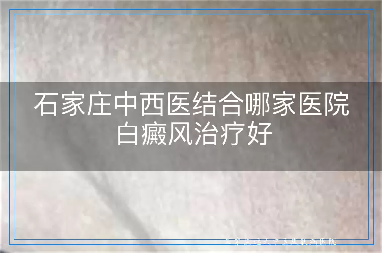 石家庄中西医结合哪家医院白癜风治疗好