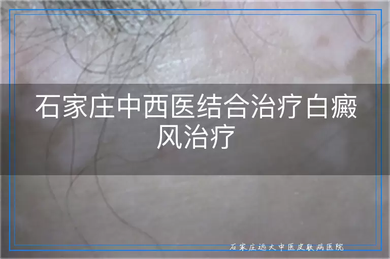 石家庄中西医结合治疗白癜风治疗