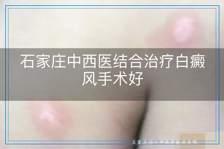 石家庄中西医结合治疗白癜风手术好
