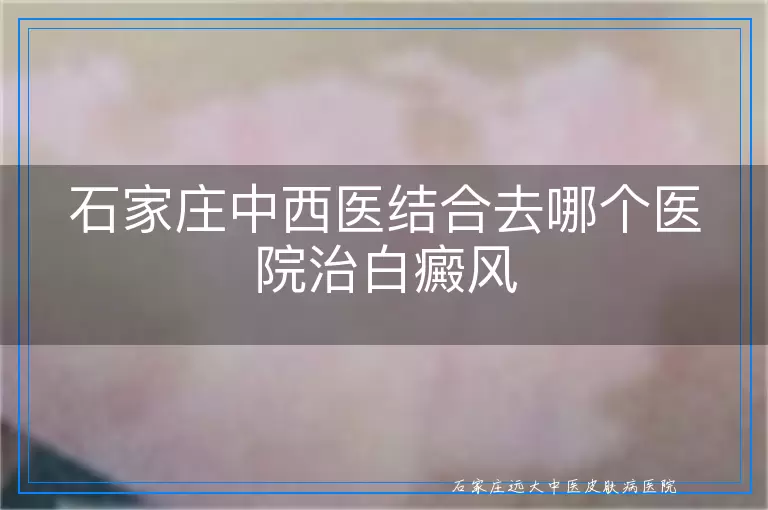 石家庄中西医结合去哪个医院治白癜风