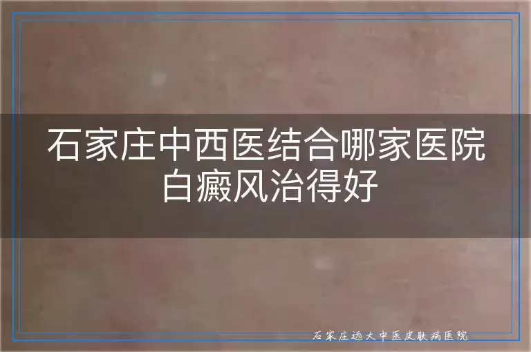 石家庄中西医结合哪家医院白癜风治得好