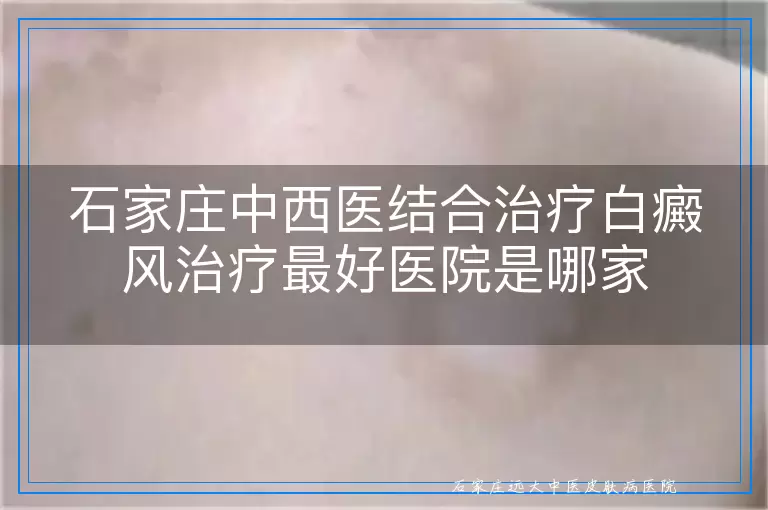 石家庄中西医结合治疗白癜风治疗最好医院是哪家