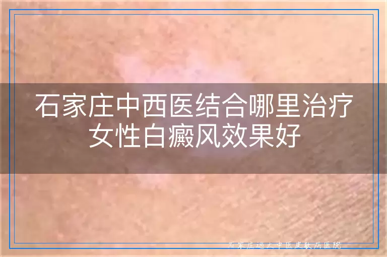 石家庄中西医结合哪里治疗女性白癜风效果好