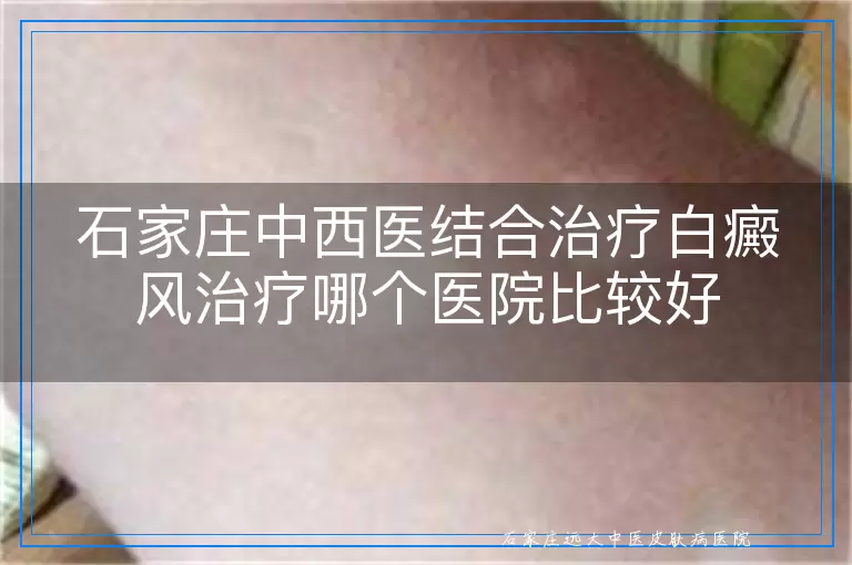 石家庄中西医结合治疗白癜风治疗哪个医院比较好