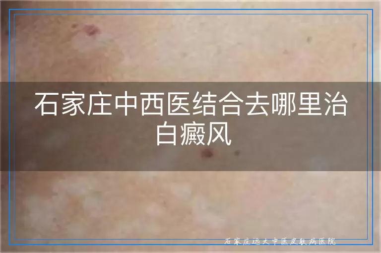 石家庄中西医结合去哪里治白癜风