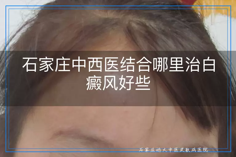 石家庄中西医结合哪里治白癜风好些