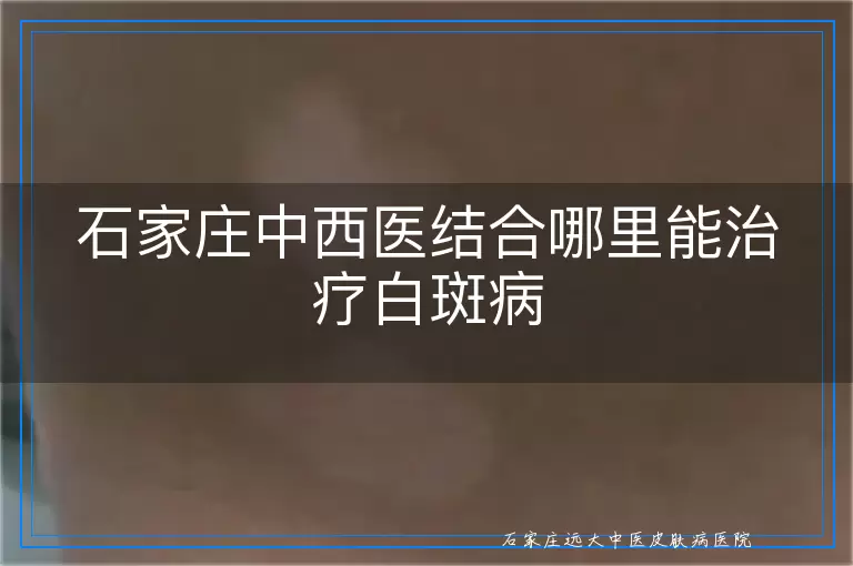 石家庄中西医结合哪里能治疗白斑病