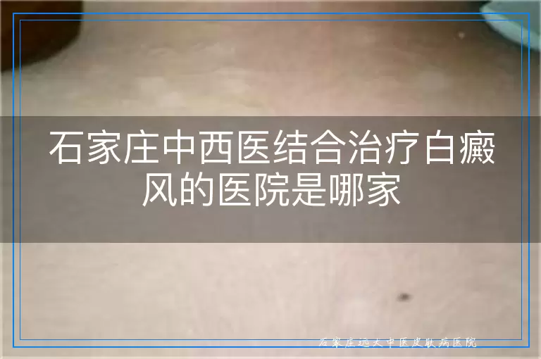 石家庄中西医结合治疗白癜风的医院是哪家