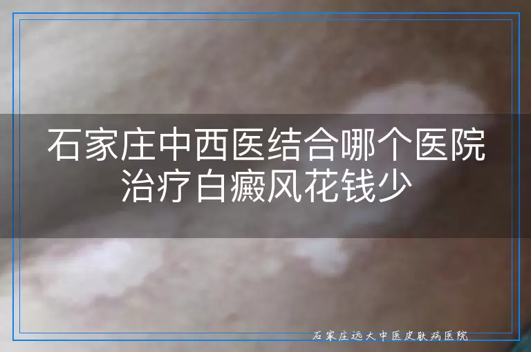 石家庄中西医结合哪个医院治疗白癜风花钱少
