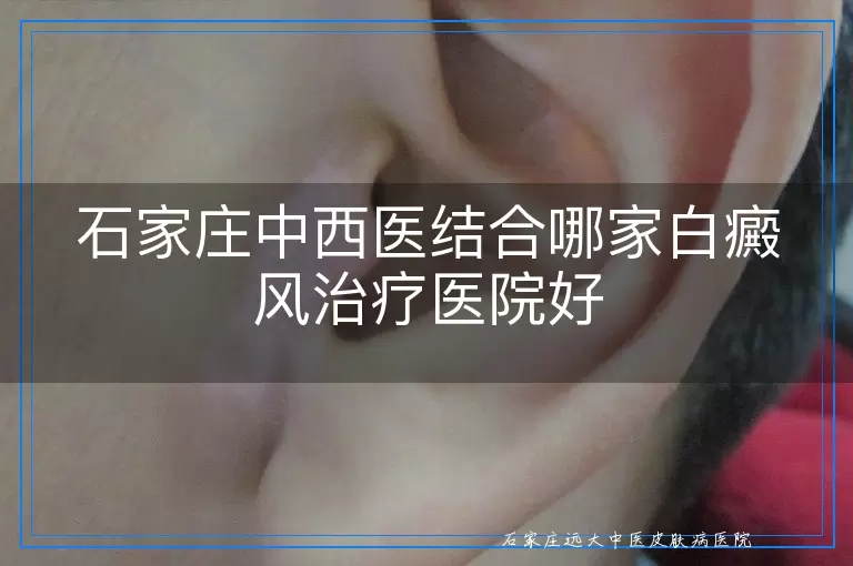 石家庄中西医结合哪家白癜风治疗医院好