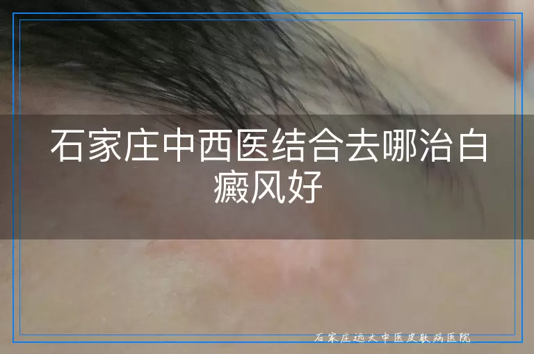 石家庄中西医结合去哪治白癜风好