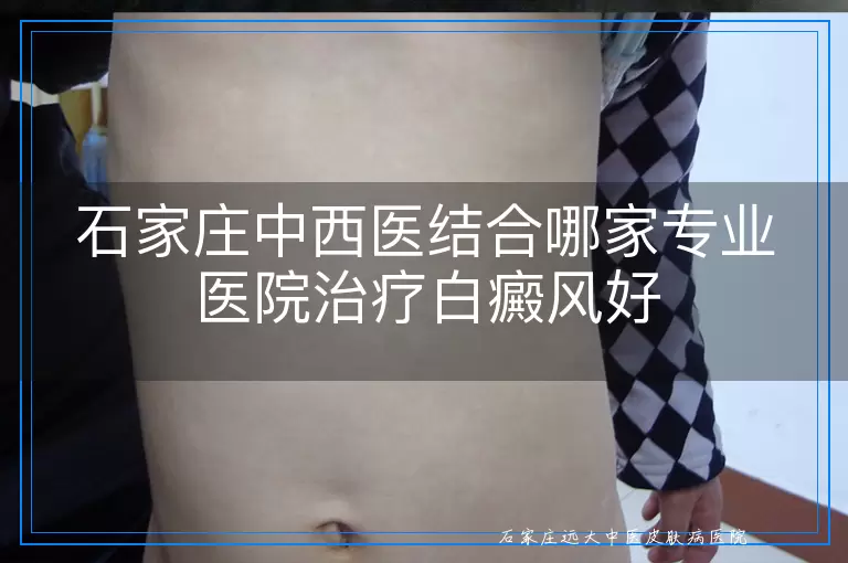石家庄中西医结合哪家专业医院治疗白癜风好