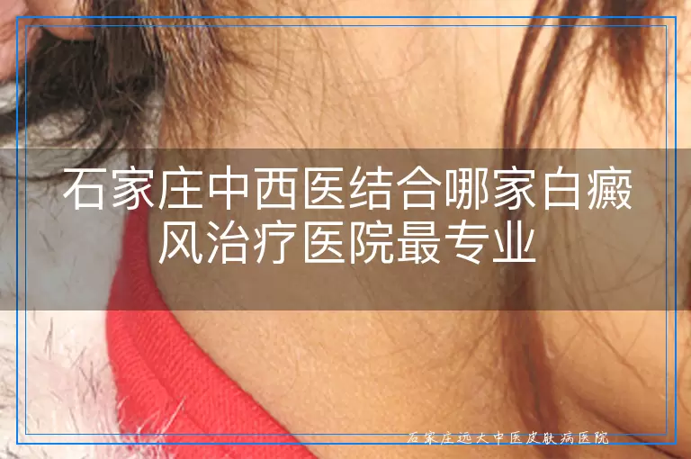 石家庄中西医结合哪家白癜风治疗医院最专业