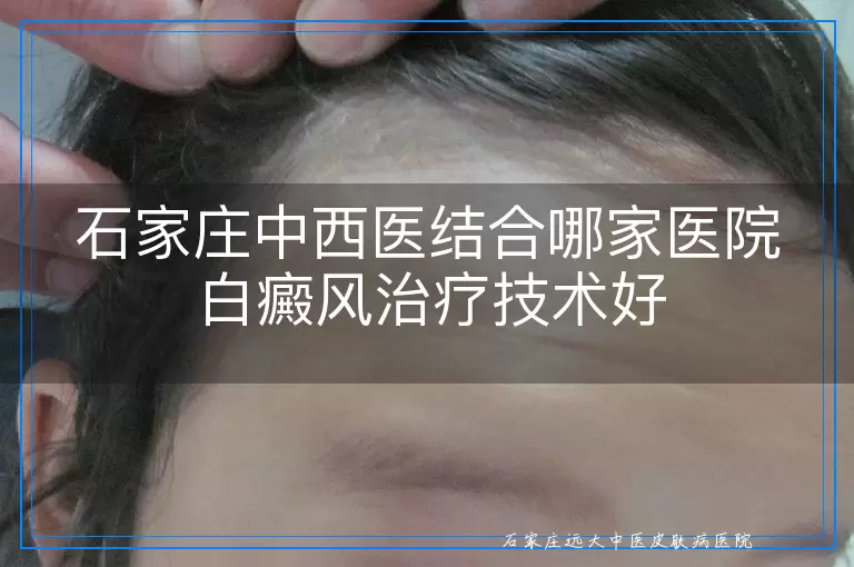 石家庄中西医结合哪家医院白癜风治疗技术好
