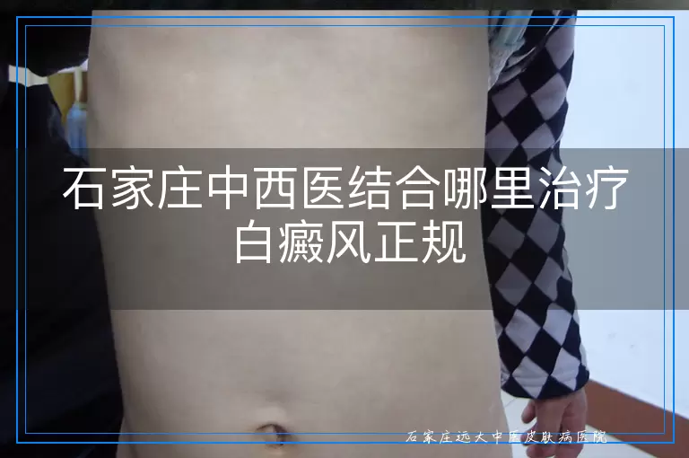 石家庄中西医结合哪里治疗白癜风正规