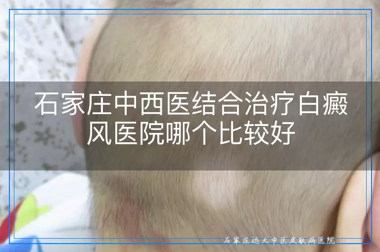 石家庄中西医结合治疗白癜风医院哪个比较好