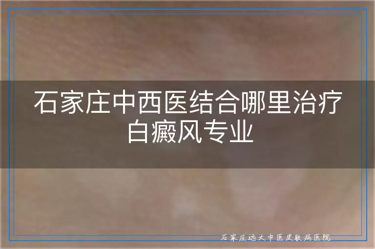 石家庄中西医结合哪里治疗白癜风专业