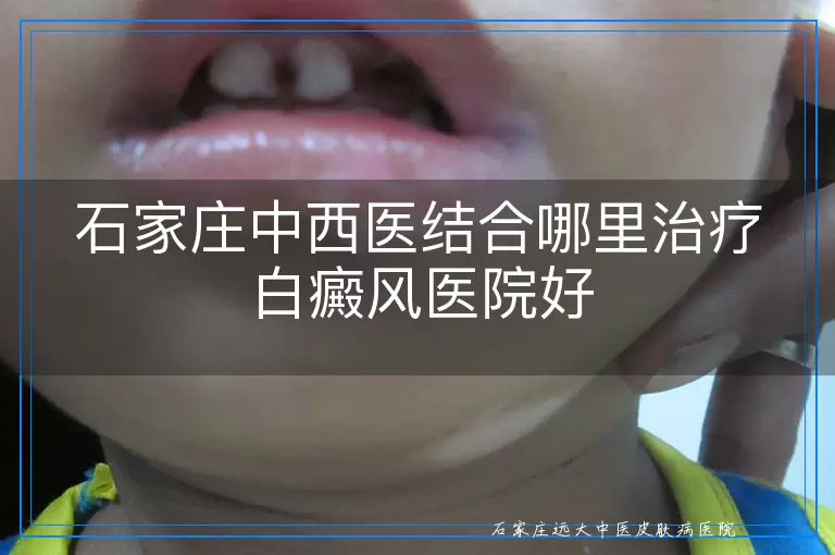 石家庄中西医结合哪里治疗白癜风医院好