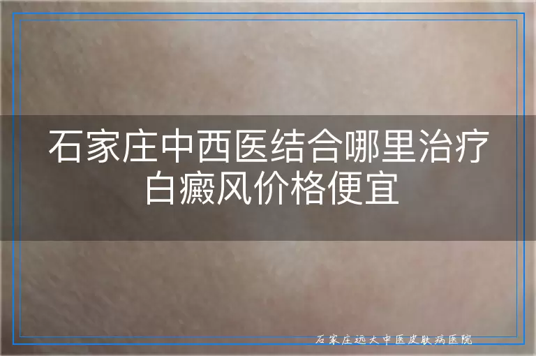 石家庄中西医结合哪里治疗白癜风价格便宜