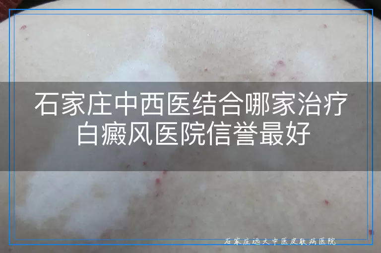 石家庄中西医结合哪家治疗白癜风医院信誉最好