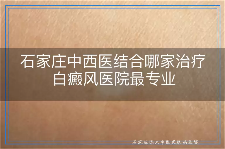 石家庄中西医结合哪家治疗白癜风医院最专业
