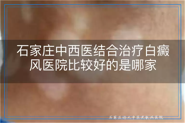 石家庄中西医结合治疗白癜风医院比较好的是哪家
