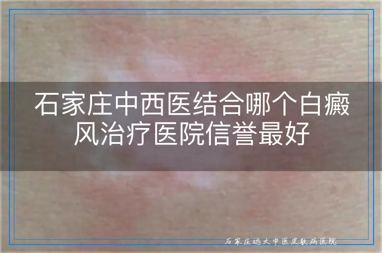 石家庄中西医结合哪个白癜风治疗医院信誉最好
