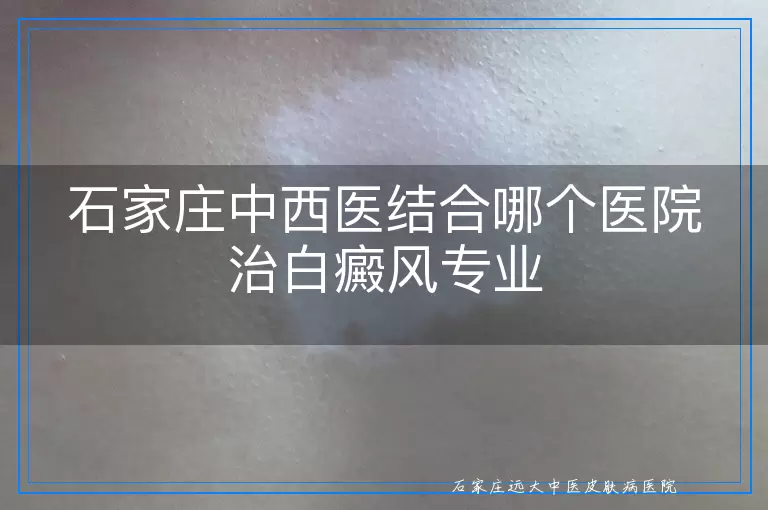 石家庄中西医结合哪个医院治白癜风专业