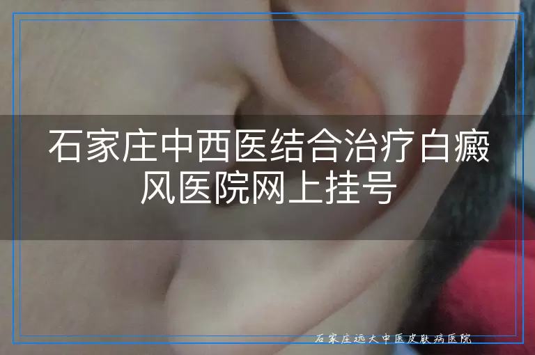 石家庄中西医结合治疗白癜风医院网上挂号