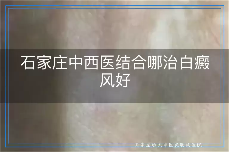 石家庄中西医结合哪治白癜风好