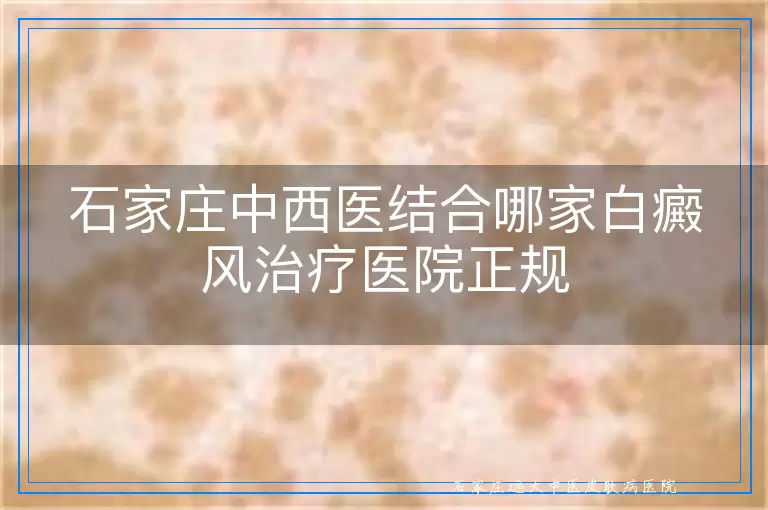 石家庄中西医结合哪家白癜风治疗医院正规