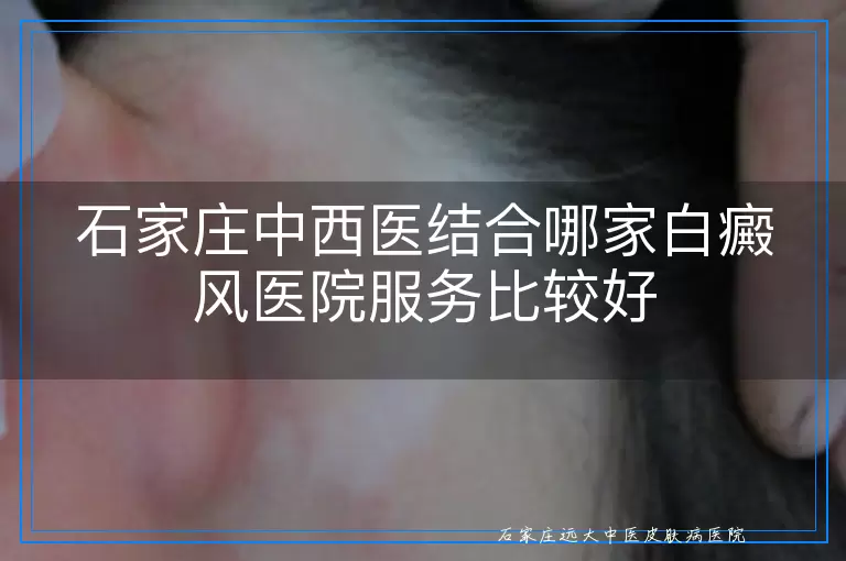 石家庄中西医结合哪家白癜风医院服务比较好