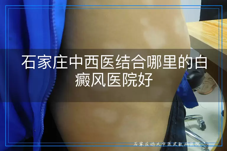 石家庄中西医结合哪里的白癜风医院好