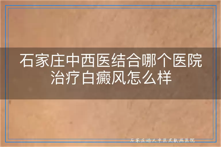 石家庄中西医结合哪个医院治疗白癜风怎么样
