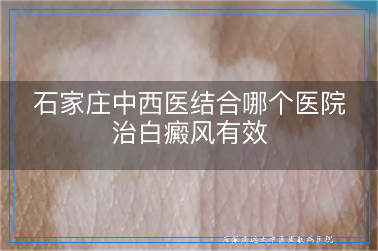 石家庄中西医结合哪个医院治白癜风有效
