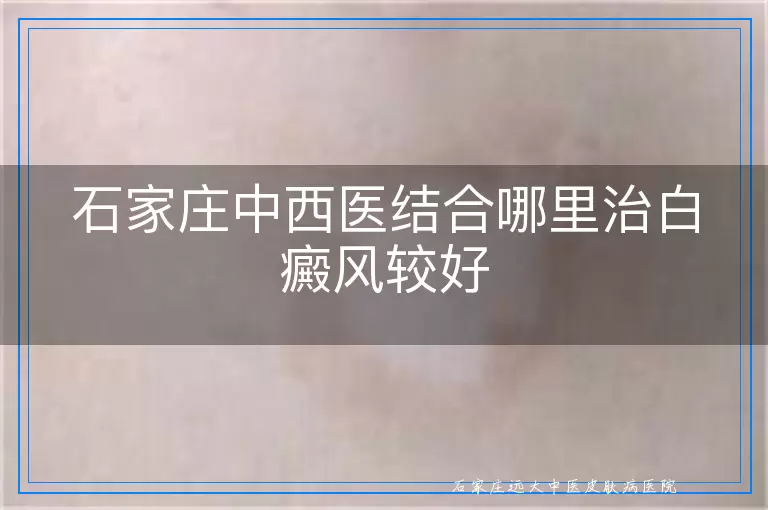 石家庄中西医结合哪里治白癜风较好