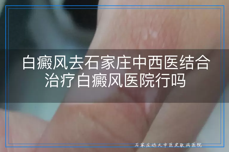 白癜风去石家庄中西医结合治疗白癜风医院行吗